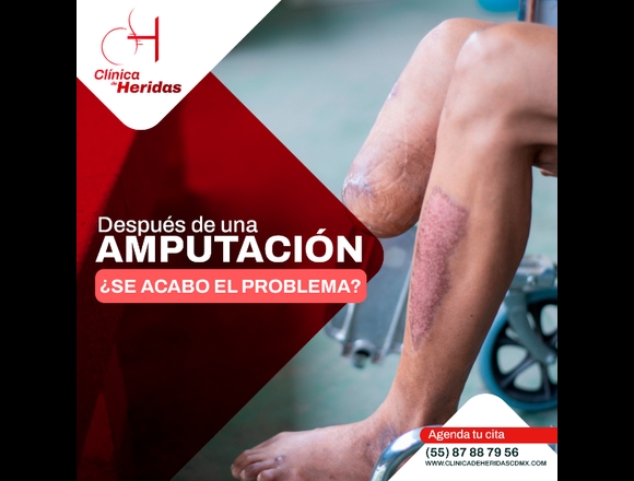 Curación post amputación