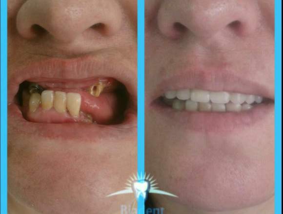 Prótesis dental todo tipo elaboramos en Bogotá, D.C. (Municipio)