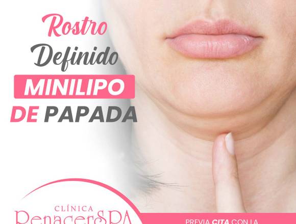 Lipolaser de papada Reduce la grasa de la papa en Miraflores (Distrito)