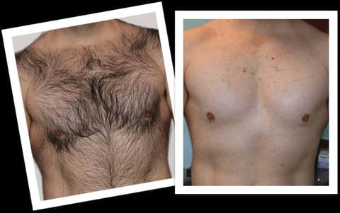 professional hair removal services for men and women