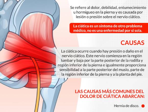 Evita el dolor de ciática en Cuauhtémoc (Municipio)