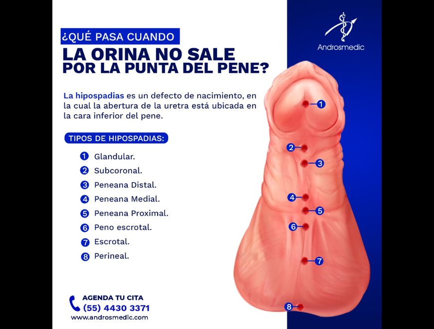 El #hipospadias es un defecto de nacimiento en Querétaro (Municipio)