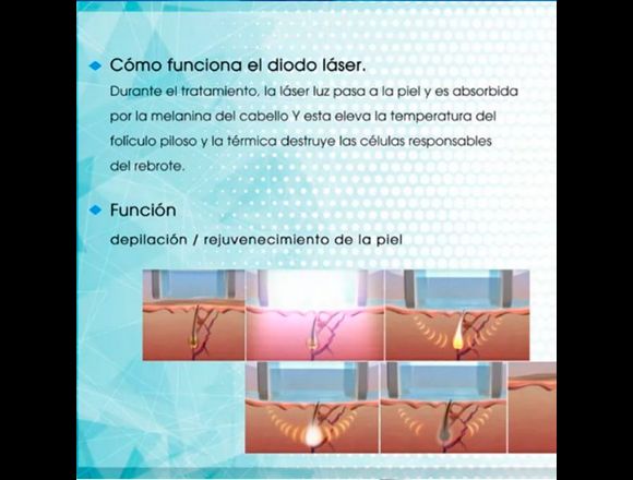 Depilador laser ice tipo soprano 1080 nm en Barranco (Lima 4) (Distrito)