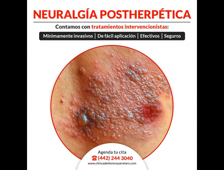 NEURALGÍA POSTHERPÉTICA, te ha arruidado la vida?