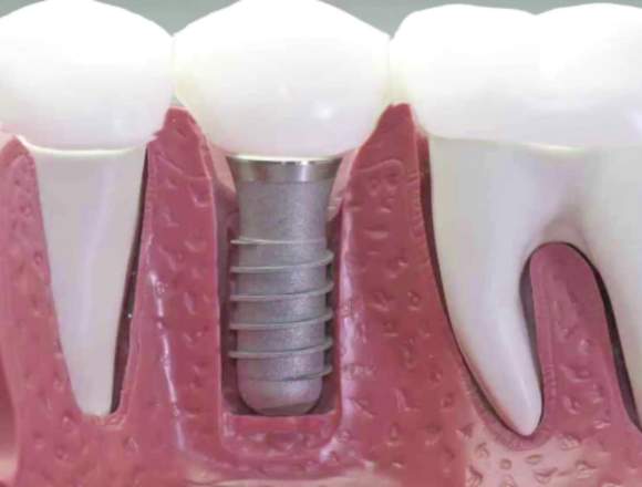 CAMPAÑA PARA PAGAR GASTOS DE IMPLANTES DENTALES en Morelos (Municipio)