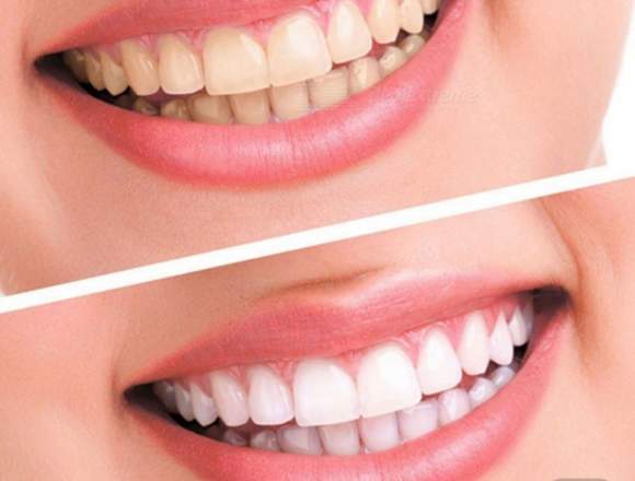 Kit de blanqueamiento dental en Veracruz (Municipio)