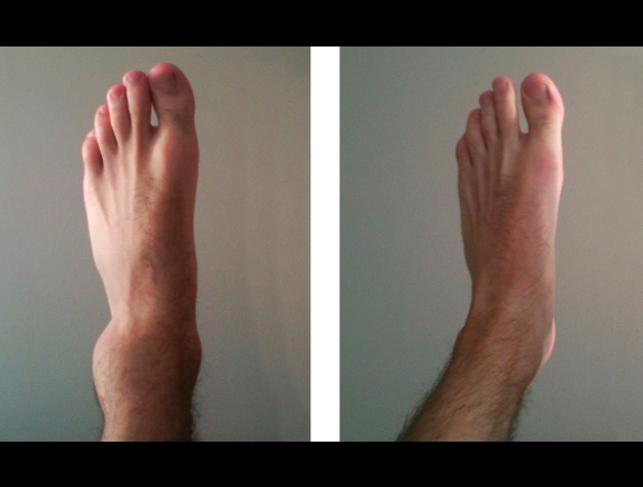 Fisioterapia con Diatermia en Barcelona (Municipio)