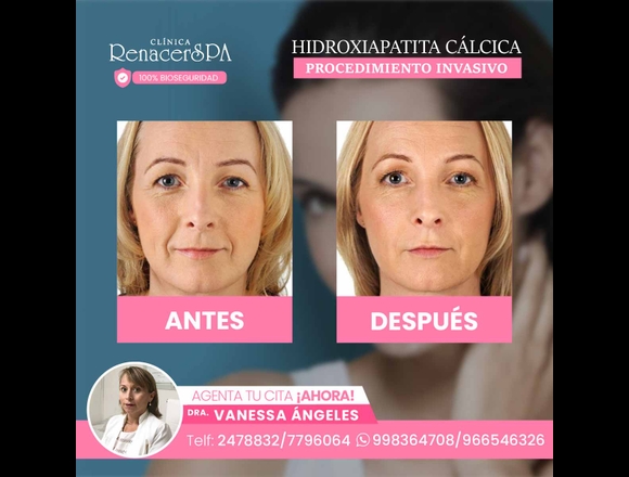 Hidroxiapatita cálcica – Beneficios en San Luis (Lima 30) (Distrito)
