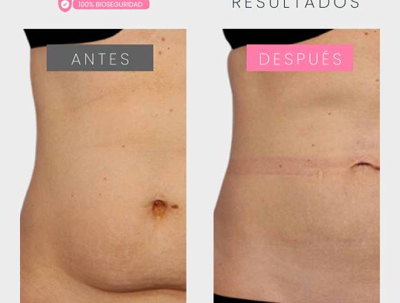 Criolipólisis - medicina estetica en San Borja (Lima 41) (Distrito)