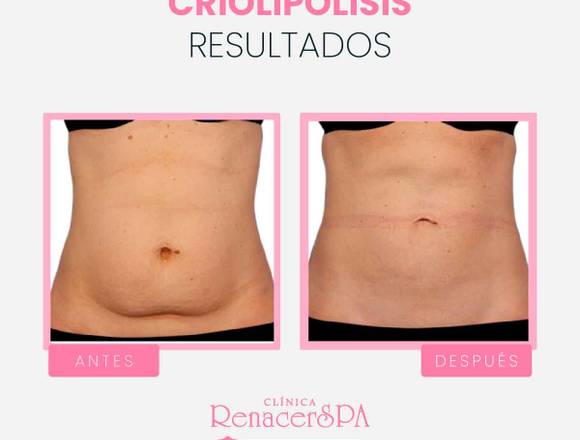 Criolipólisis – antes y después en Surquillo (Lima 34) (Distrito)