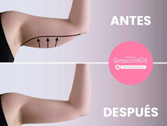 Brazos delgados – lipolaser en San Luis (Lima 30) (Distrito)
