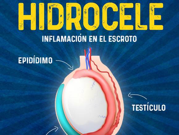 Hidrocele .,-..-..,.,.,-