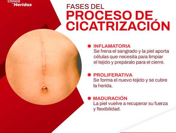 ¿Heridas de difícil cicatrización? en Querétaro (Municipio)