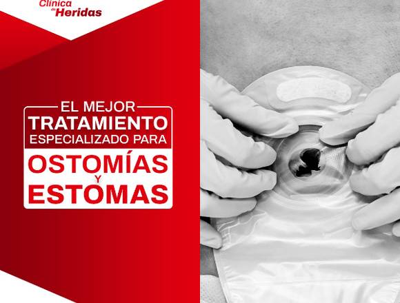 Tratamiento para ostomías y estomas en Cuauhtémoc (Municipio)